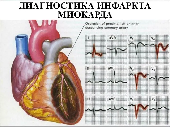 ДИАГНОСТИКА ИНФАРКТА МИОКАРДА