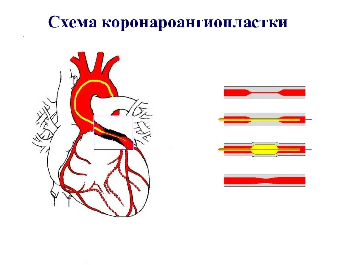 Схема коронароангиопластки