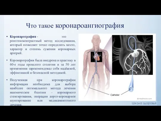 Что такое коронароангиография Коронарография - это рентгеноконтрастный метод исследования, который позволяет