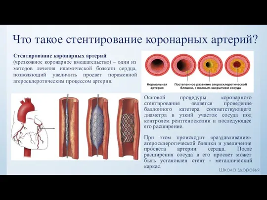 Что такое стентирование коронарных артерий? Основой процедуры коронарного стентирования является проведение