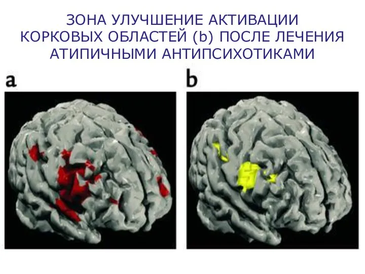 ЗОНА УЛУЧШЕНИЕ АКТИВАЦИИ КОРКОВЫХ ОБЛАСТЕЙ (b) ПОСЛЕ ЛЕЧЕНИЯ АТИПИЧНЫМИ АНТИПСИХОТИКАМИ
