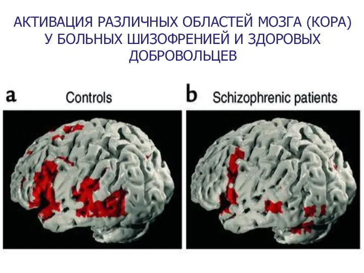 АКТИВАЦИЯ РАЗЛИЧНЫХ ОБЛАСТЕЙ МОЗГА (КОРА) У БОЛЬНЫХ ШИЗОФРЕНИЕЙ И ЗДОРОВЫХ ДОБРОВОЛЬЦЕВ