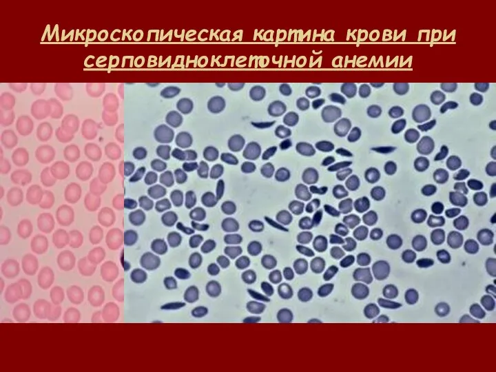 Микроскопическая картина крови при серповидноклеточной анемии