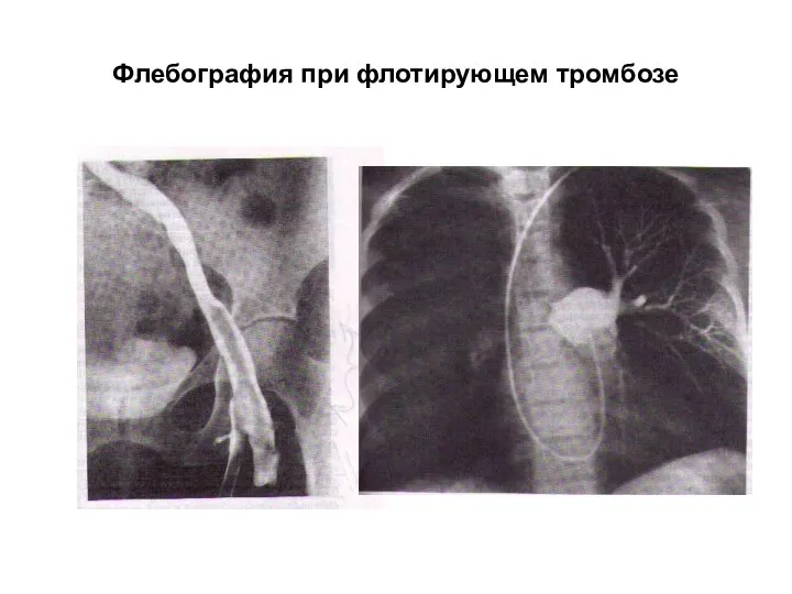 Флебография при флотирующем тромбозе