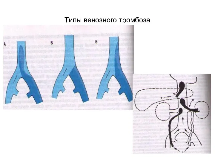 Типы венозного тромбоза