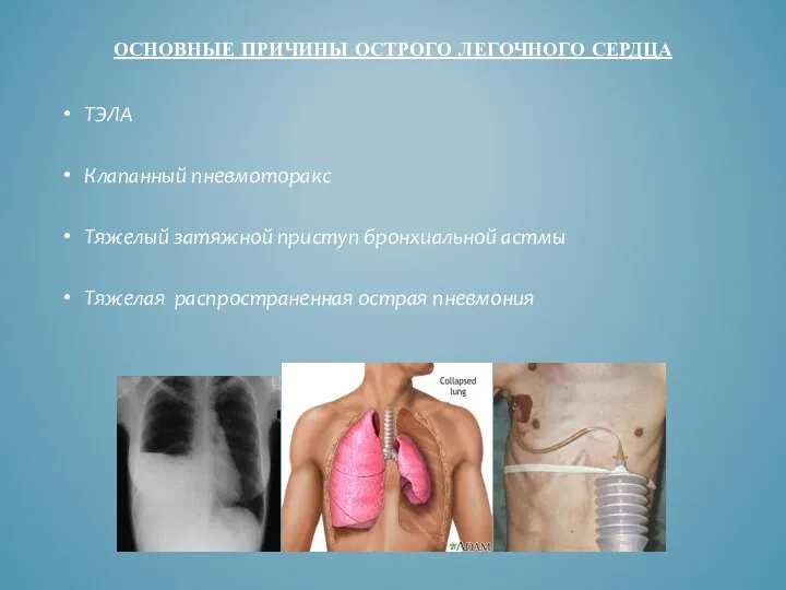 ОСНОВНЫЕ ПРИЧИНЫ ОСТРОГО ЛЕГОЧНОГО СЕРДЦА ТЭЛА Клапанный пневмоторакс Тяжелый затяжной приступ