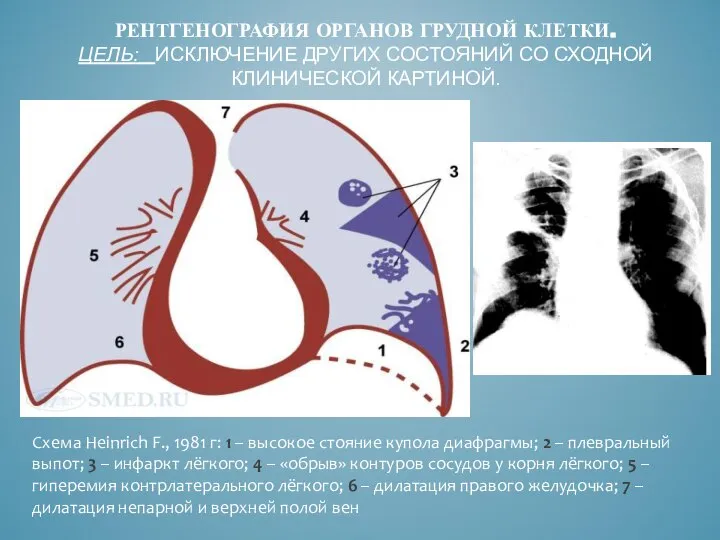 РЕНТГЕНОГРАФИЯ ОРГАНОВ ГРУДНОЙ КЛЕТКИ. ЦЕЛЬ: ИСКЛЮЧЕНИЕ ДРУГИХ СОСТОЯНИЙ СО СХОДНОЙ КЛИНИЧЕСКОЙ