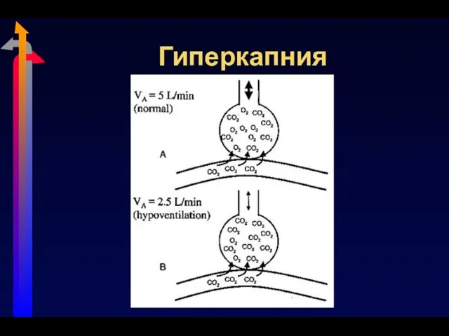 Гиперкапния