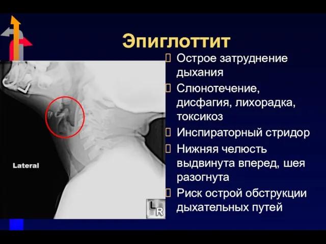 Эпиглоттит Острое затруднение дыхания Слюнотечение, дисфагия, лихорадка, токсикоз Инспираторный стридор Нижняя