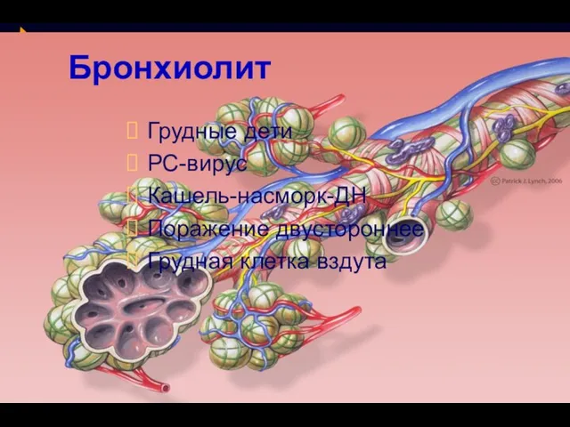 Бронхиолит Грудные дети РС-вирус Кашель-насморк-ДН Поражение двустороннее Грудная клетка вздута