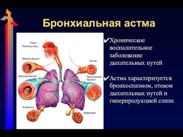 Бронхиальная астма Хроническое воспалительное заболевание дыхательных путей Астма характеризуется бронхоспазмом, отеком дыхательных путей и гиперпродукцией слизи