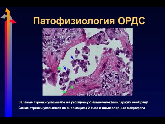 Патофизиология ОРДС Зеленые стрелки указывают на утолщенную альвеоло-каппилярную мембрану Синие стрелки