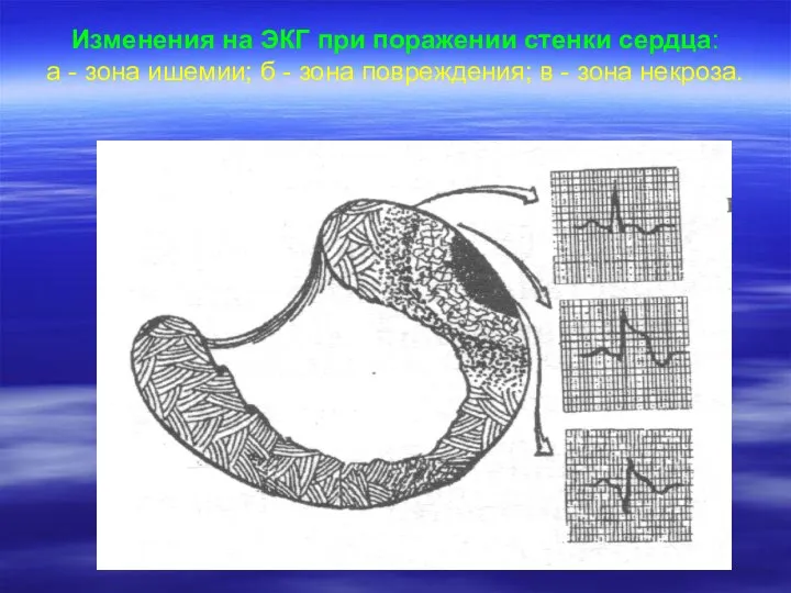 Изменения на ЭКГ при поражении стенки сердца: а - зона ишемии;