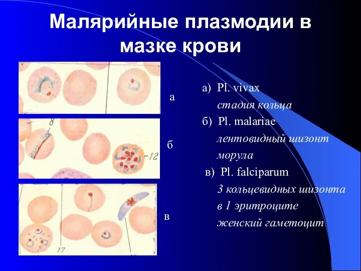 Малярийные плазмодии в мазке крови а) Pl. vivax стадия кольца б)