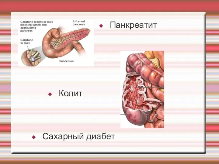 Панкреатит Колит Сахарный диабет