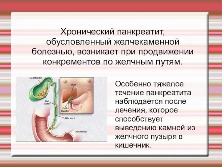 Хронический панкреатит, обусловленный желчекаменной болезнью, возникает при продвижении конкрементов по желчным