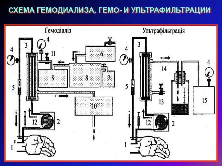 СХЕМА ГЕМОДИАЛИЗА, ГЕМО- И УЛЬТРАФИЛЬТРАЦИИ