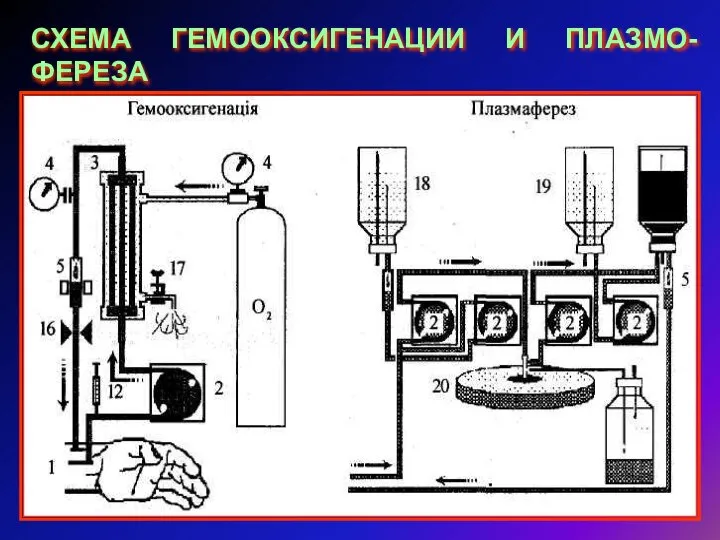 СХЕМА ГЕМООКСИГЕНАЦИИ И ПЛАЗМО-ФЕРЕЗА