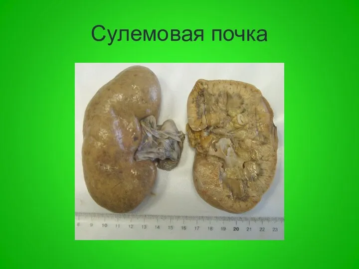 Сулемовая почка