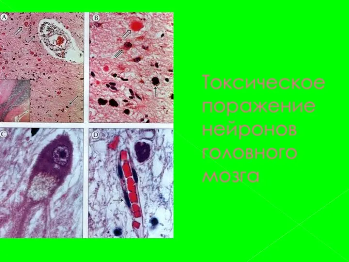 Токсическое поражение нейронов головного мозга