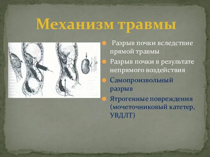 Разрыв почки вследствие прямой травмы Разрыв почки в результате непрямого воздействия