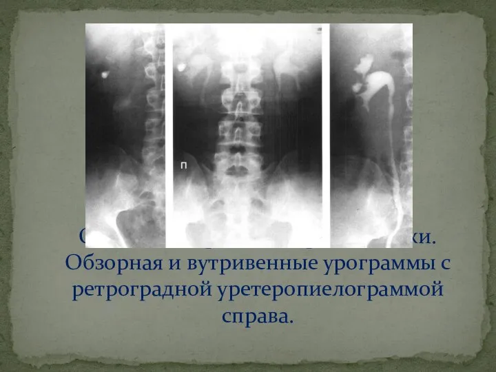 Осколочное ранение правой почки. Обзорная и вутривенные урограммы с ретроградной уретеропиелограммой справа.