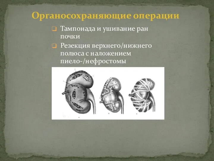 Тампонада и ушивание ран почки Резекция верхнего/нижнего полюса с наложением пиело-/нефростомы Органосохраняющие операции