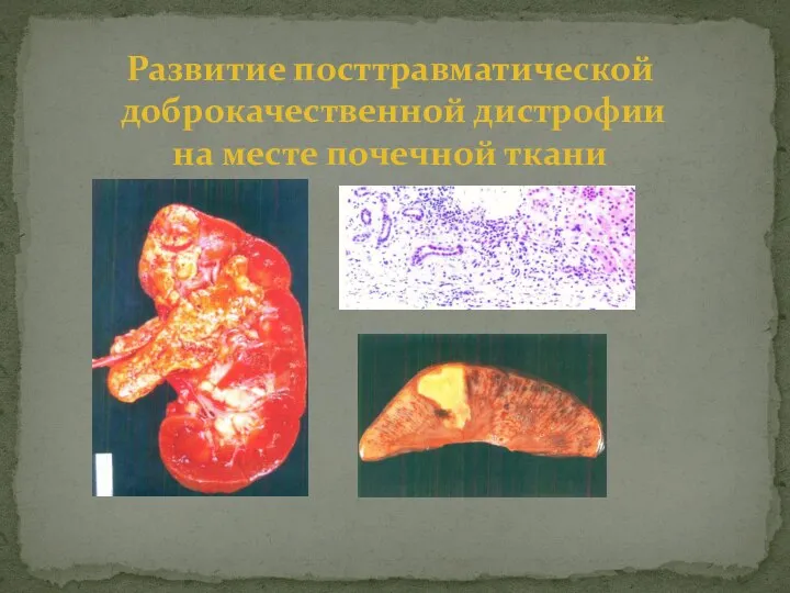 Развитие посттравматической доброкачественной дистрофии на месте почечной ткани