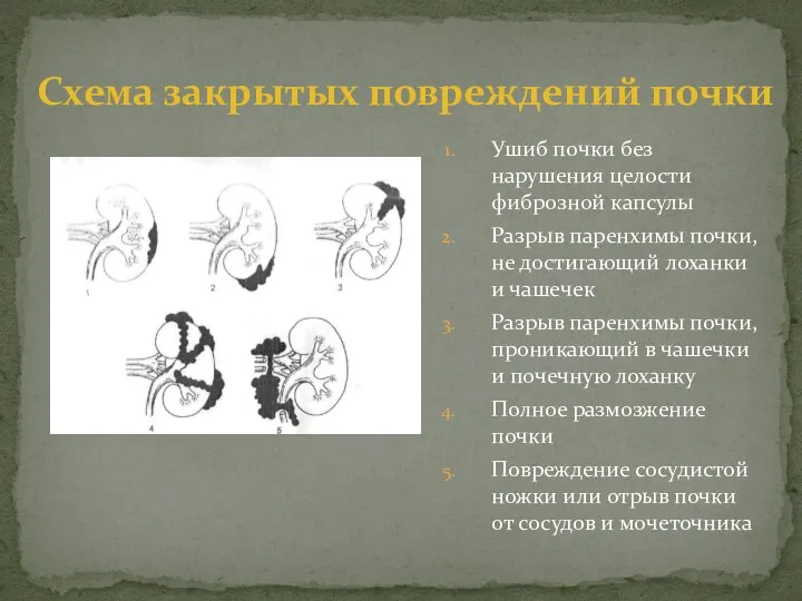 Ушиб почки без нарушения целости фиброзной капсулы Разрыв паренхимы почки, не