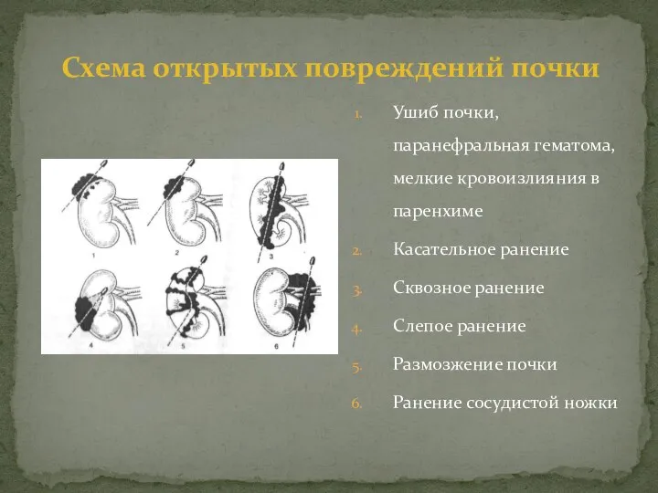 Ушиб почки, паранефральная гематома, мелкие кровоизлияния в паренхиме Касательное ранение Сквозное