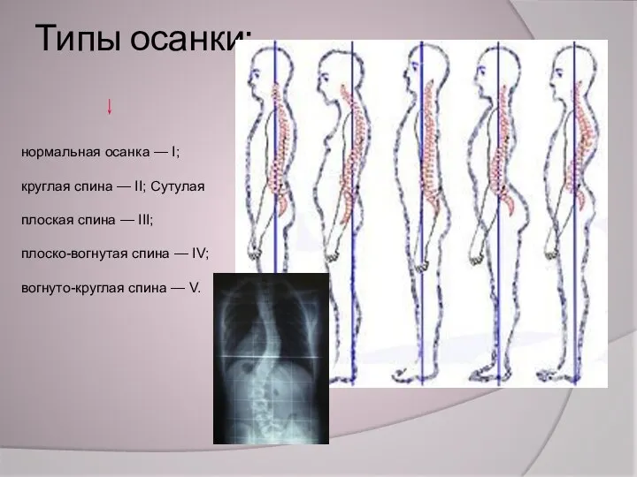 Типы осанки: нормальная осанка — I; круглая спина — II; Сутулая