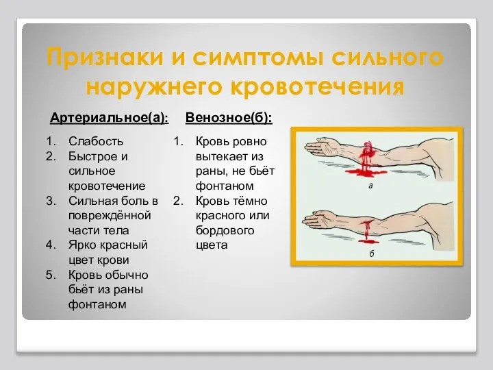 Признаки и симптомы сильного наружнего кровотечения Артериальное(а): Слабость Быстрое и сильное