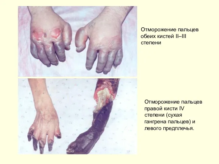 Отморожение пальцев обеих кистей II–III степени Отморожение пальцев правой кисти IV