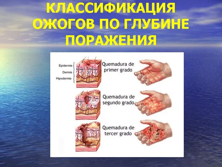 КЛАССИФИКАЦИЯ ОЖОГОВ ПО ГЛУБИНЕ ПОРАЖЕНИЯ