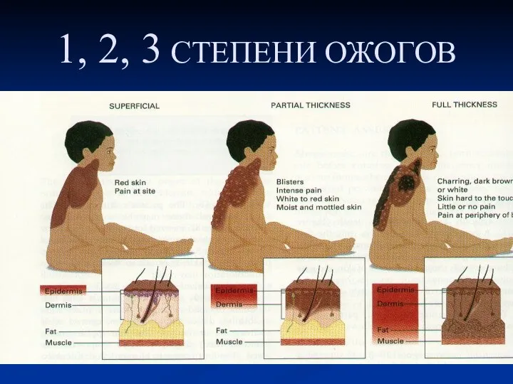 1, 2, 3 СТЕПЕНИ ОЖОГОВ