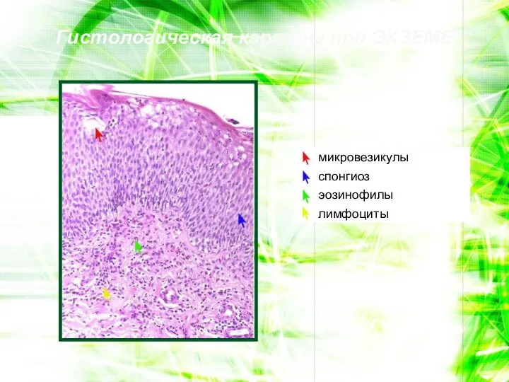 Гистологическая картина при ЭКЗЕМЕ микровезикулы спонгиоз эозинофилы лимфоциты