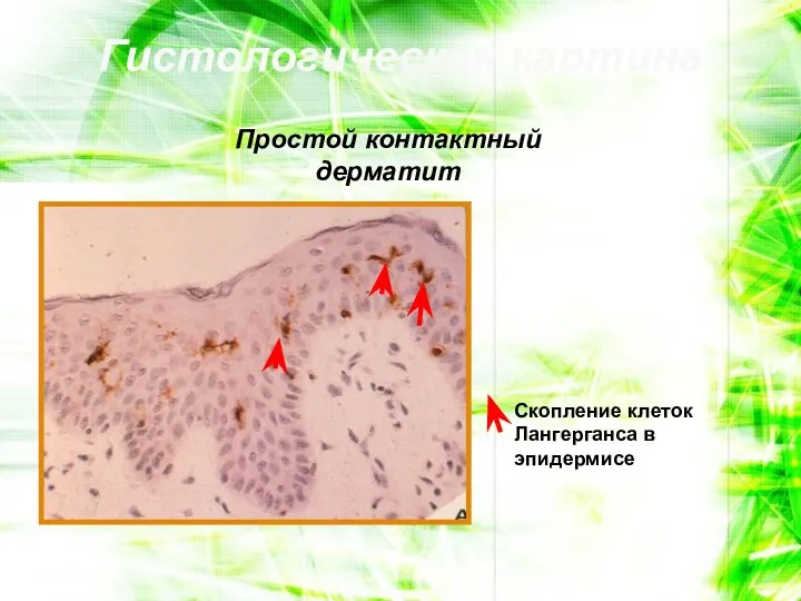 Гистологическая картина Простой контактный дерматит Скопление клеток Лангерганса в эпидермисе