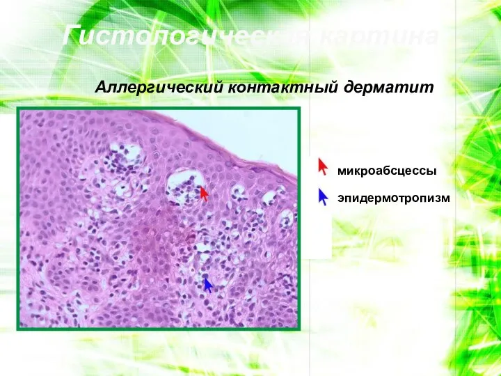 Гистологическая картина Аллергический контактный дерматит микроабсцессы эпидермотропизм