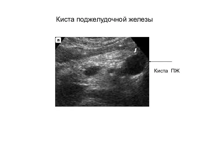 Киста поджелудочной железы Киста ПЖ