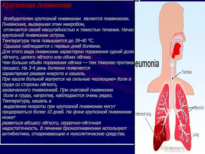 Крупозная пневмония Возбудителем крупозной пневмонии является пневмококк. Пневмония, вызванная этим микробом,
