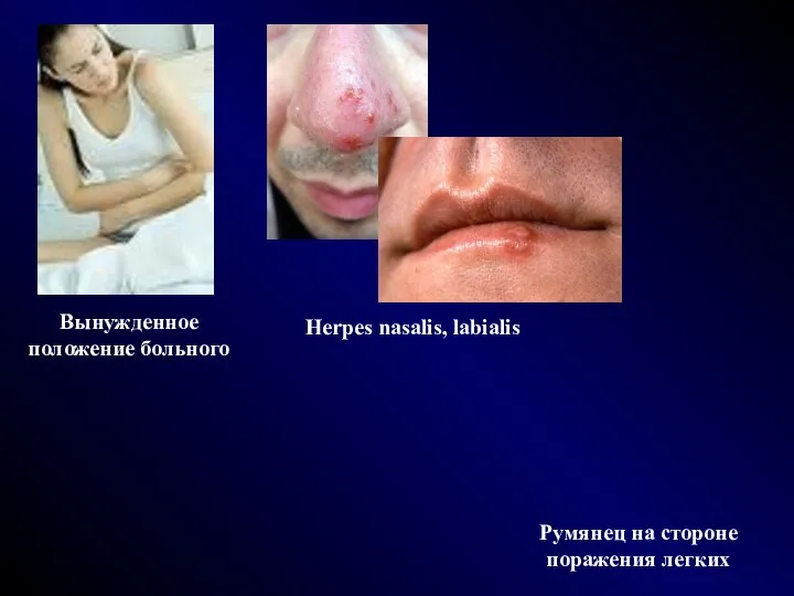 Вынужденное положение больного Herpes nasalis, labialis Румянец на стороне поражения легких