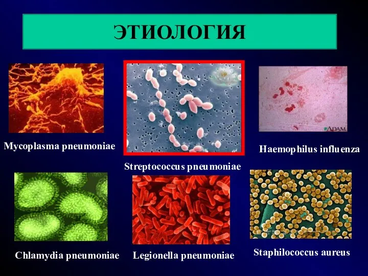 ЭТИОЛОГИЯ Mycoplasma pneumoniae Streptococcus pneumoniae Haemophilus influenza Chlamydia pneumoniae Legionella pneumoniae Staphilococcus aureus