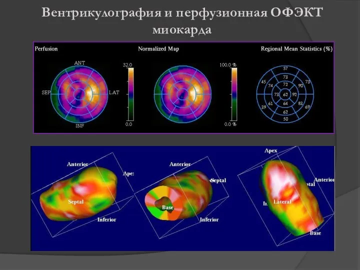 Вентрикулография и перфузионная ОФЭКТ миокарда