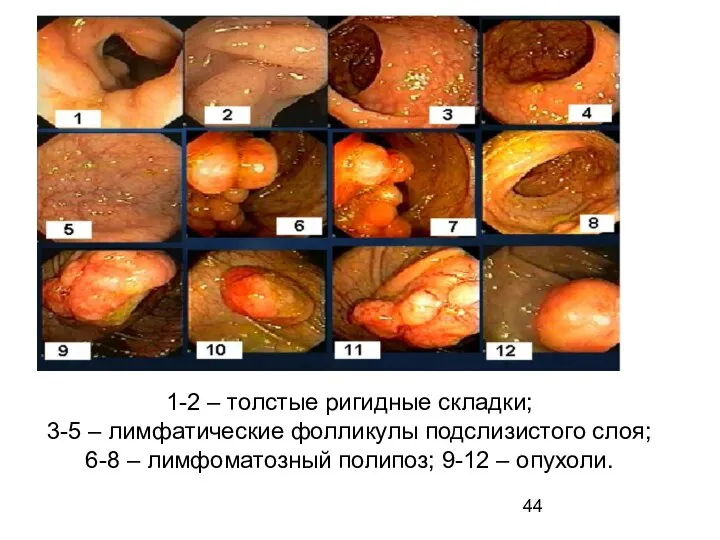 1-2 – толстые ригидные складки; 3-5 – лимфатические фолликулы подслизистого слоя;