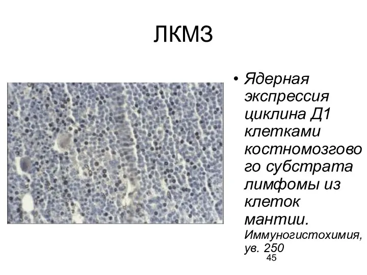 ЛКМЗ Ядерная экспрессия циклина Д1 клетками костномозгового субстрата лимфомы из клеток мантии. Иммуногистохимия, ув. 250