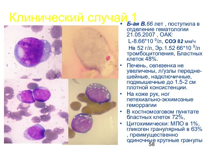 Клинический случай 1 Б-ая В.66 лет , поступила в отделение гематологии