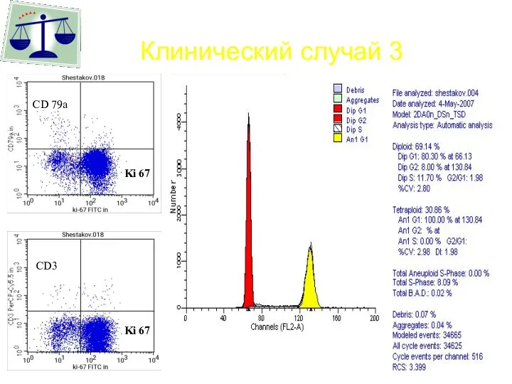 Клинический случай 3 Ki 67 Ki 67 CD 79a CD3