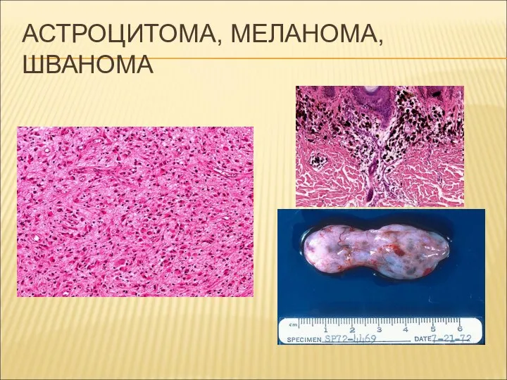 АСТРОЦИТОМА, МЕЛАНОМА, ШВАНОМА
