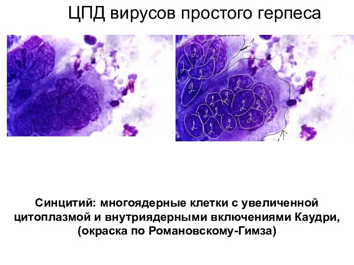 ЦПД вирусов простого герпеса Синцитий: многоядерные клетки с увеличенной цитоплазмой и