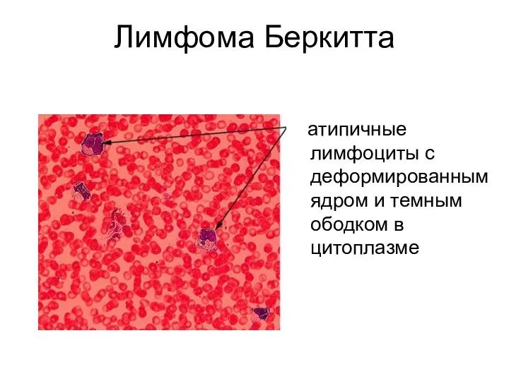 Лимфома Беркитта атипичные лимфоциты с деформированным ядром и темным ободком в цитоплазме